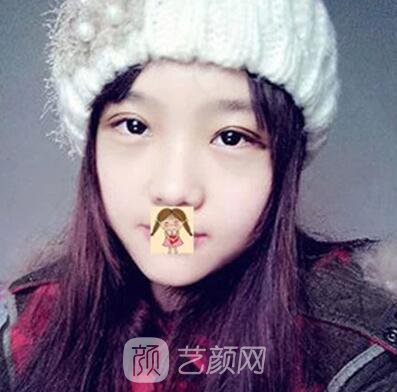 我做的埋线也挺自然的~~有图有真相