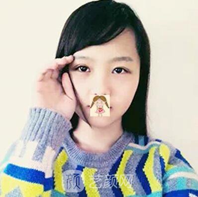 我做的埋线也挺自然的~~有图有真相