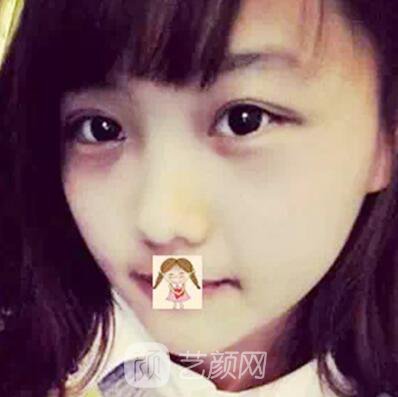 我做的埋线也挺自然的~~有图有真相