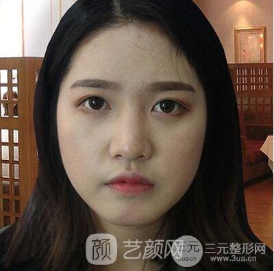 终于下定决心做了隆鼻手术，果棒棒哒~~