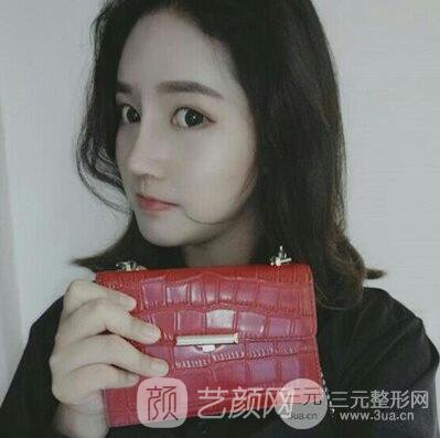 终于下定决心做了隆鼻手术，果棒棒哒~~