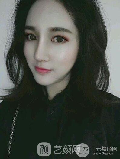 终于下定决心做了隆鼻手术，果棒棒哒~~