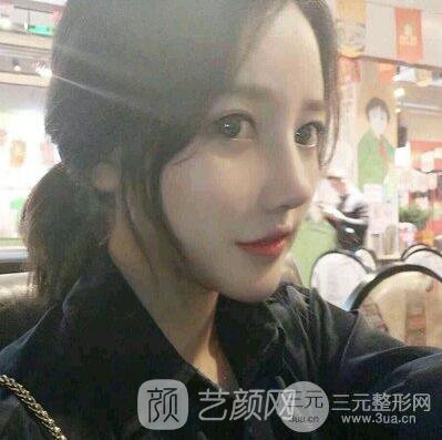 终于下定决心做了隆鼻手术，果棒棒哒~~