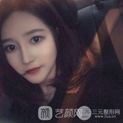 终于下定决心做了隆鼻手术，果棒棒哒~~