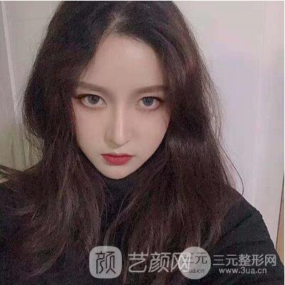 终于下定决心做了隆鼻手术，果棒棒哒~~