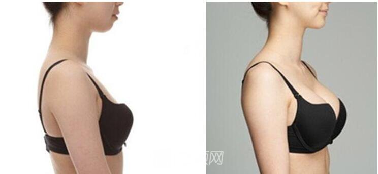 做中美合资假体丰胸做不好也会让人很痛苦 给兄弟姐妹揭秘