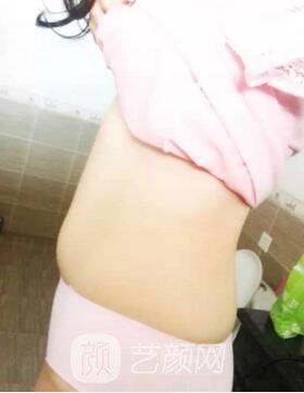 腰部吸脂,终于甩掉了大肚腩