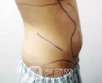 腰部吸脂,终于甩掉了大肚腩