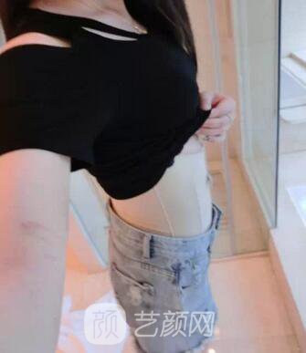 腰部吸脂,终于甩掉了大肚腩