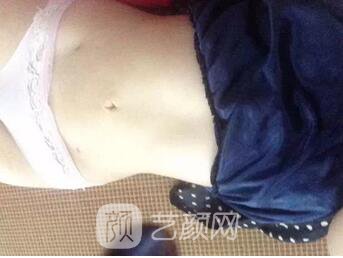 腰部吸脂,终于甩掉了大肚腩