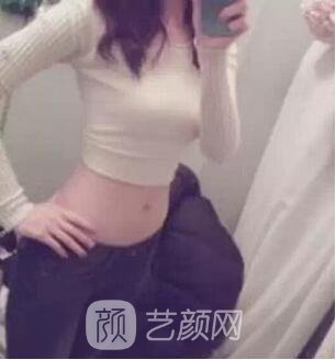 腰部吸脂,终于甩掉了大肚腩