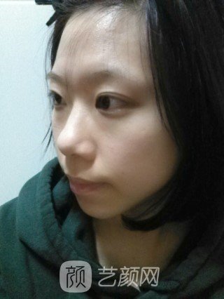 分享自己的自体脂肪移植,隆鼻+翼缩小