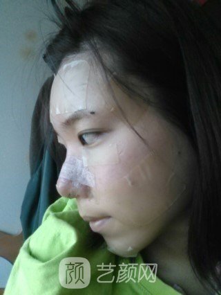 分享自己的自体脂肪移植,隆鼻+翼缩小