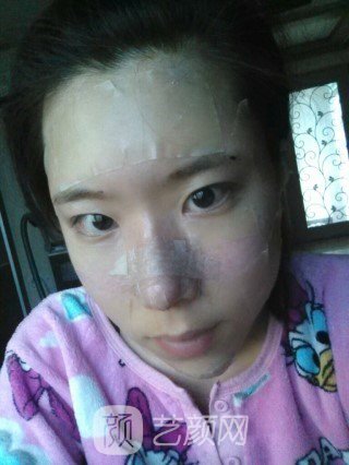 分享自己的自体脂肪移植,隆鼻+翼缩小