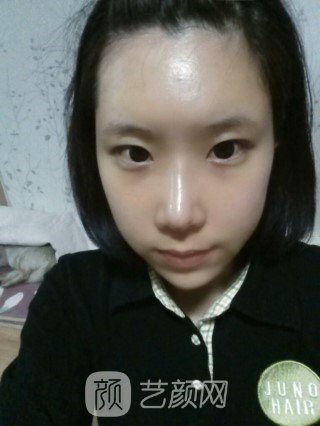 分享自己的自体脂肪移植,隆鼻+翼缩小