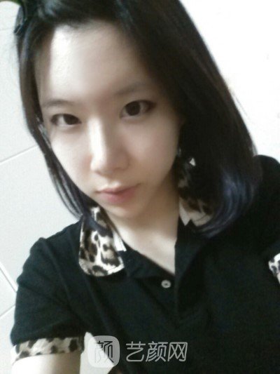 分享自己的自体脂肪移植,隆鼻+翼缩小