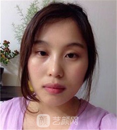 磨腮削骨填额头决心大变身