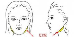 上海切除咬肌价格多少？