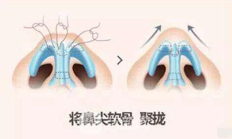 鼻翼缩小手术喔，爱美就行动哦