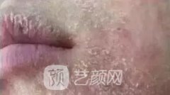天天敷面膜，咋会越来越干？