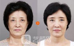 上海久愿面部自体脂肪填充多少钱?