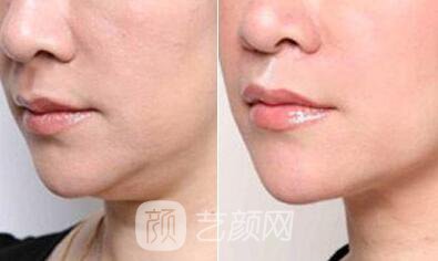下巴整形果图,让我们改变原有的面貌