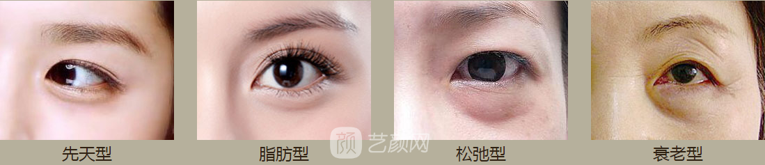 成都美未央祛眼袋价格多少?