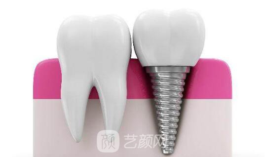 牙齿种植与假牙有什么区别?