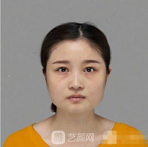 扬州郭军下颌角案例，通过下颌角整形大脸变成瓜子脸