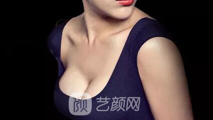 娜高乳房假体隆胸一个月后 挺胸走路找回了自信