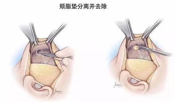 去八大处去颊脂垫价格多少