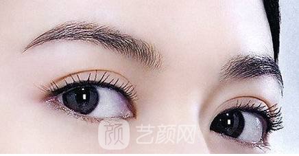双眼皮两个月，是这个样子的，大家来看看