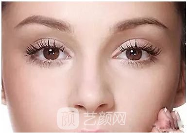 做完双眼皮两个月，简直跟换了个人似的