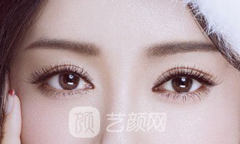 做完双眼皮两个月，简直跟换了个人似的