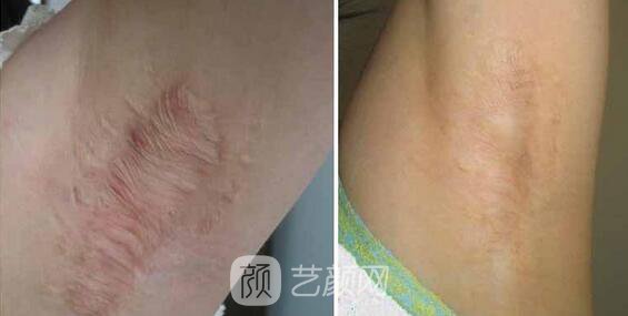 广州曙光美容医院疤痕专家怎样