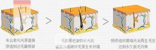 南昌红苹果做脱毛怎么样?我们用实际情况来说话