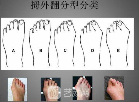 去大脚骨的医院金华有吗?