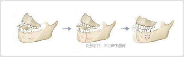 如何阻止地包天的发生，专业医生为你解答