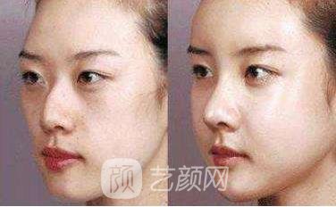 华人医联整形做驼峰鼻手术漂亮鼻形美丽无限