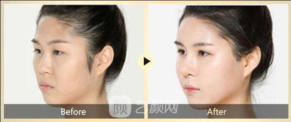 脸部下垂怎样改良和保养方法