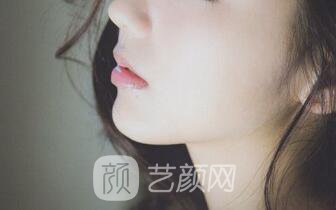 隆鼻案例:隆鼻+双眼皮+下巴已经不是原来自卑的我了~