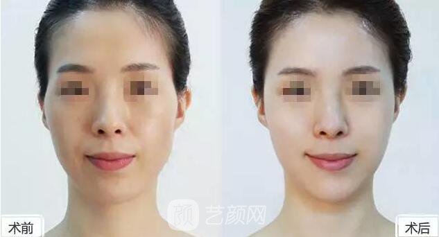 玻尿酸到底是什么东西,小编为你解剖分析