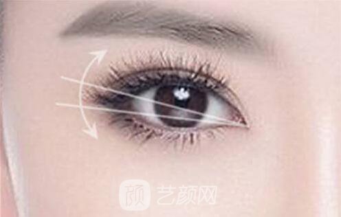 韩式切开双眼皮的真实过程及恢复体验分享~~