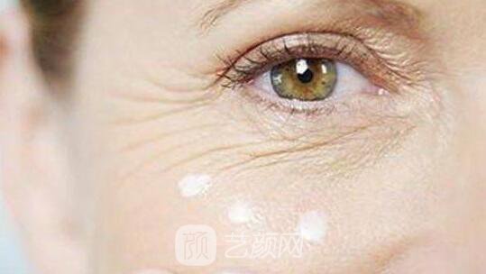 面部去皱术有很多,选适合自己的才是王道