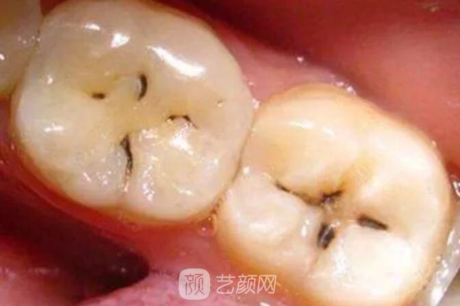 一口牙里，哪颗牙齿较容易长蛀牙？