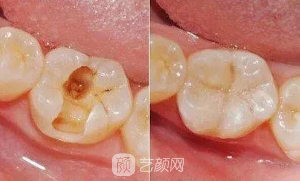 一口牙里，哪颗牙齿较容易长蛀牙？
