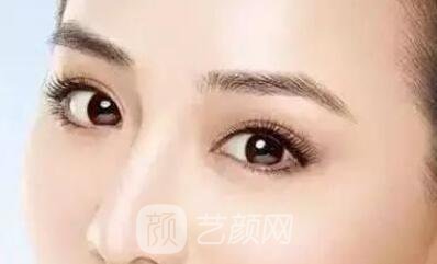 埋线双眼皮的果不是******的？