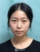 沈阳杏林双眼皮手术，让她彻底告别“土气”秒变“洋气”！