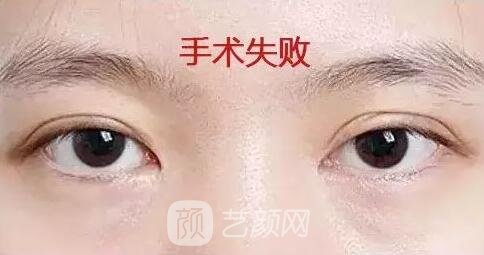 双眼皮失败的情况