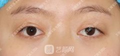 上瞼下垂的小伙伴想沒想過你也可以這樣做！